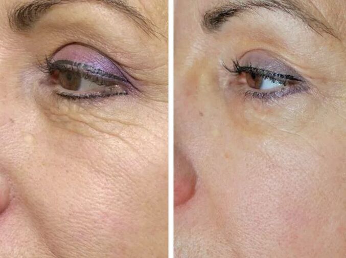 Laser field before and after