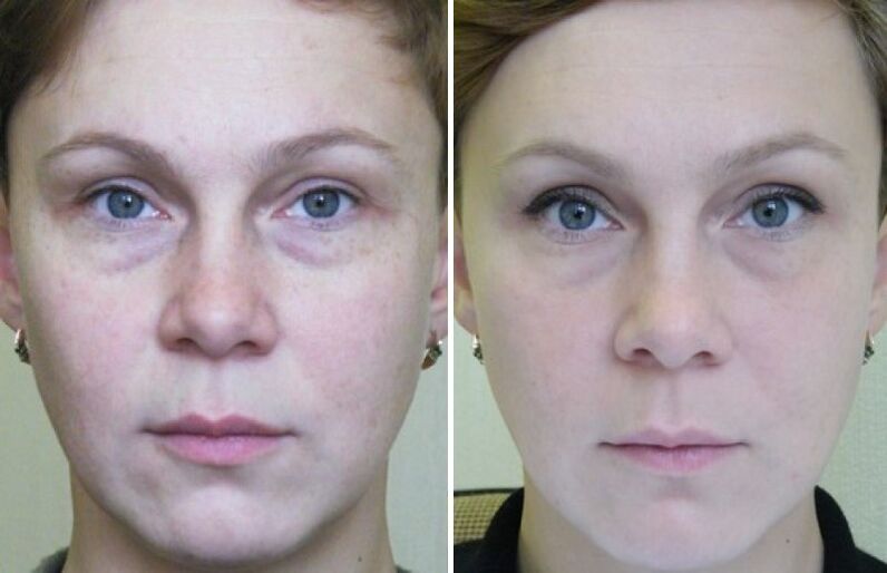 Photos before and after laser rejuvenation